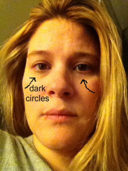 dark circles
